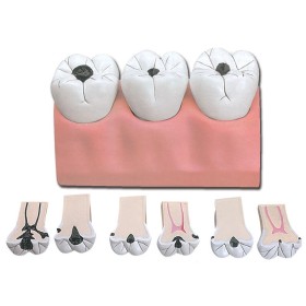 Modèle de carie dentaire