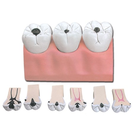 Modèle de carie dentaire