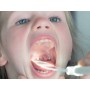 Halsrohr-Set - leuchtender Zungenspatel (1 Griff + 50 Klingen) - Blister