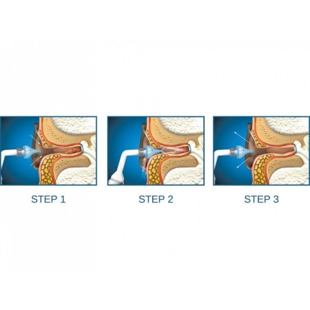 Kit otoclear - 1 kit