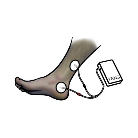 Perineálny elektrostimulátor pre inkontinenciu beac intellistim be-28ug