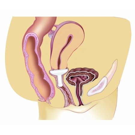 Gellhorn pessary short stem uterine prolapse diameter 57 mm