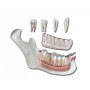Mandibula - 6 dijelova