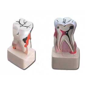 Modell der Zahnpathologie