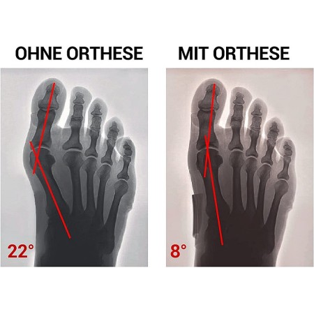 Epitact - orteză corectivă flexibilă pentru zi - medie