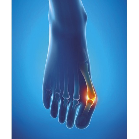 Epitact - protecție pentru hallux valgus - mare (42-45)