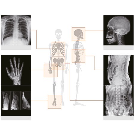 Kit de radiographie remex ka6 composé d’une caméra, d’un détecteur 43x43cm et d’un ordinateur portable avec logiciel