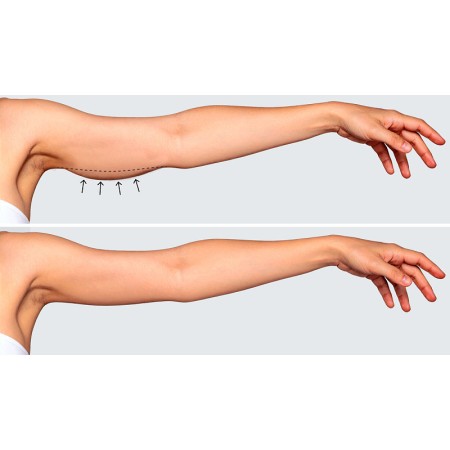 Ultrasuoni per la bellezza ultrasonicwaves beauty dotazione corpo