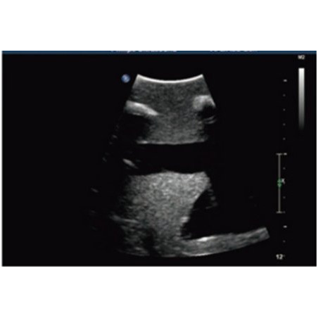 Simulatore ecografabile per addestramento alle tecniche di toracentesi e toracostomia sotto guida ecografica